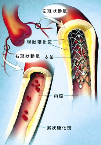 ����Ϳ��֧��
��������֧����Ѫ˨