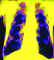 ���������Էμ������ν�չ