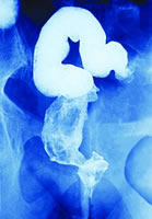 ���Գ���������к��������������ƫ�� ���Գ������ӽ᳦������Σ��,����к���ӷǻ�����ܰ�������Σ��