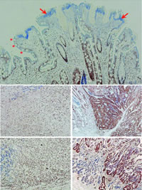 �ӵ�:PSCA�İ�֢�����