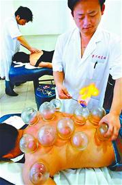 中医戒烟瘾拔罐是奇招