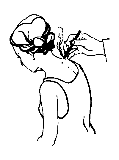 �����Ʒ�����Ӧ֢֮��׵��