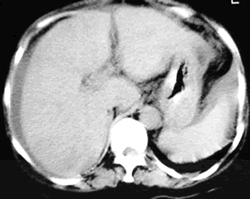 ���㡢��Ƣ��ƶѪ