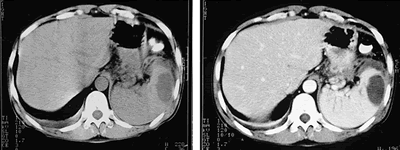 慢性胰腺炎 脾内低回声占位