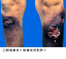 ����÷����(÷����������)//