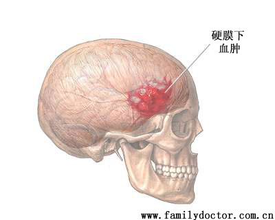 �Բ�������Ӧ֢��<br>*������<br>*�����Գ�Ѫ��Ѫ��(ӲĤ��Ѫ�׻�ӲĤ��Ѫ��)<br>*Ѫ��ȱ��(�Զ�����)<br>*������֯����(ӲĤ)<br>*���ڸ�Ⱦ��(��ŧ��)<br>*���ص���ʹ����ʹ(������ʹ��ʹ�Գ鴤)<br>*���