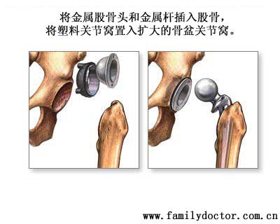 Ȼ�󽫽����ؽ�ͷ�ͽ���������ɹǣ������Ϲؽ������������˵Ĺ���ؽڰ������˹��ؽڹ̶���(������һ�������ˮ��̶�)�����Ǹ����ļ���ͼ��츴λ�����ر��пڡ��������Ų������������ϡ����з���һ��ϸ���������ų��ؽ��������Һ�塣