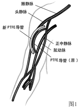 �¼�������ѪҺ͸��������ͨ·��������֢