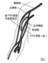 �¼�������ѪҺ͸��������ͨ·��������֢