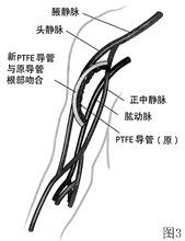 �¼�������ѪҺ͸��������ͨ·��������֢