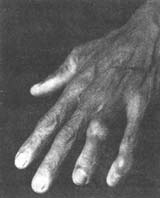 ʹ�缰������Ѫ֢