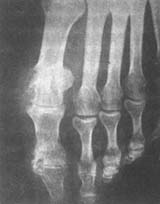 ʹ�缰������Ѫ֢