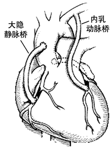 20������о���ʾCABG��PTCA��Ч����