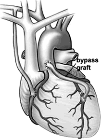 心脏手术可能使认知能力下降