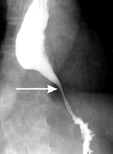 ��������������ʧ�ڻ�֢��������ѡ