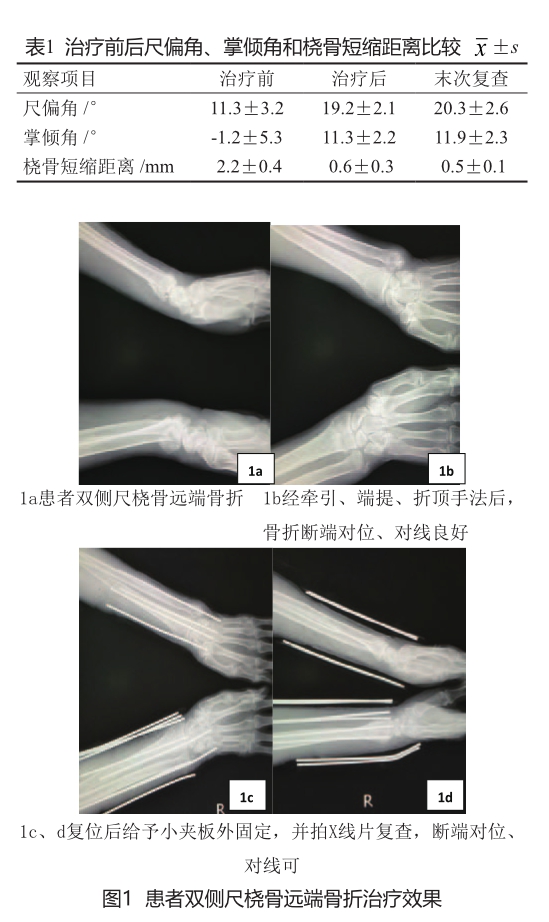 拔伸端提折顶手法整复小夹板外固定治疗伸直型桡骨远端骨折临床观察