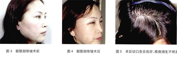 头皮分层切开和帽状腱膜覆盖减张缝合法预防额颞部除皱术后脱发