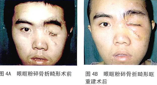 创伤性颅眶畸形的三维可视化诊断分析与手术整复