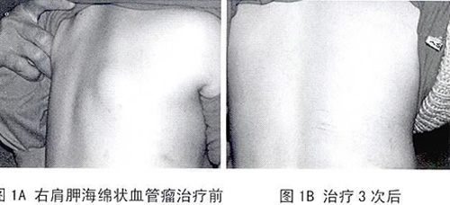 超声引导下平阳霉素注射治疗深部软组织海绵状血管瘤