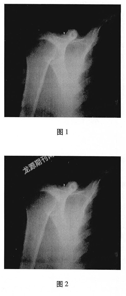 右肩胛骨并胸骨结核一例报告